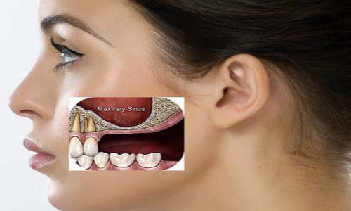 mất răng gây hóp má nên trồng răng giả loại nào