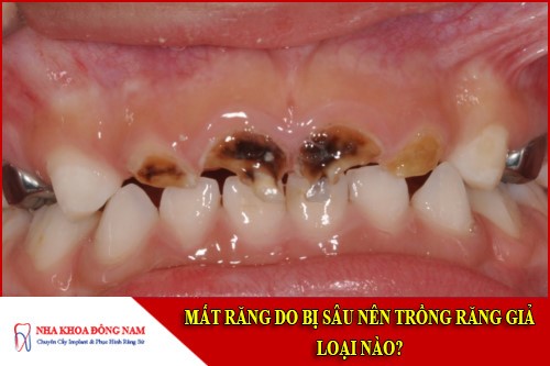 mất răng do bị sâu nên trồng răng giả loại nào