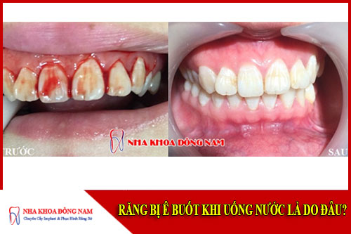 Nguyên nhân dẫn đến chãy máu răng
