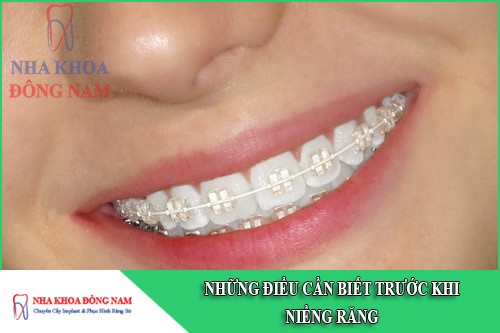 những điều cần biết trước khi niềng răng