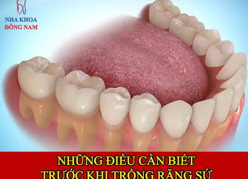 những điều cần biết về trồng răng sứ -1