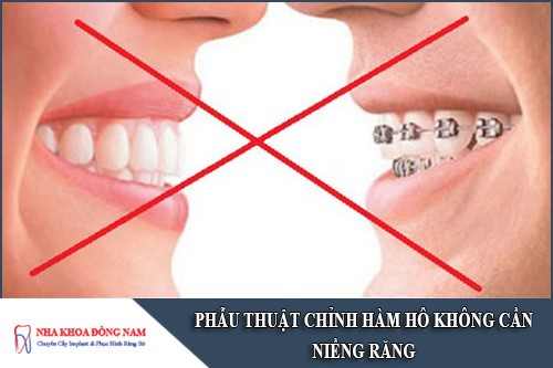 phẫu thuật chỉnh hàm hô không cần niềng răng