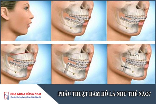 phẫu thuật hàm hô là như thế nào