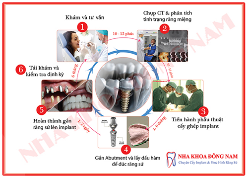 quy trình cấy ghép implant chuẩn nhất