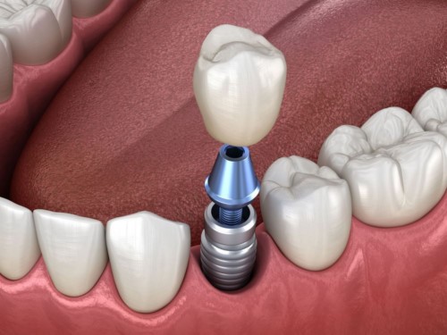 Quy Trình Cấy Ghép Răng Implant tại Nha Khoa Đông Nam®