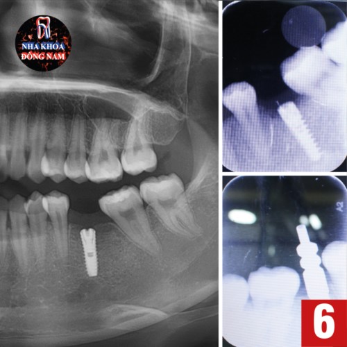 chụp film ct kiểm tra implant