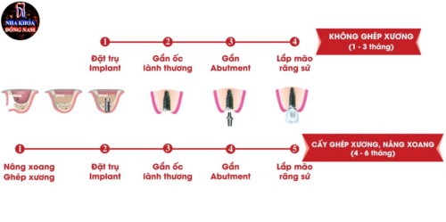 thời gian cấy ghép răng implant