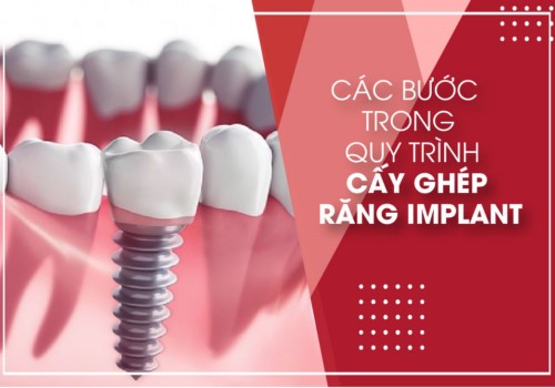 Các bước làm răng implant đầy đủ nhất