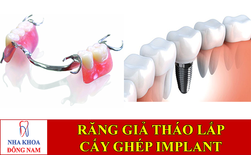 sanh sánh răng giả tháo lắp và cấy ghép implant -1