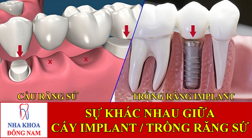 sự khác nhau giữa cấy ghép implant và trồng răng sứ -1