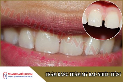 trám răng thẩm mỹ bao nhiêu tiền