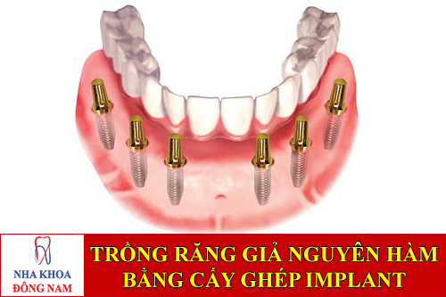 trồng răng giả nguyên hàm bằng cấy ghép implant -1