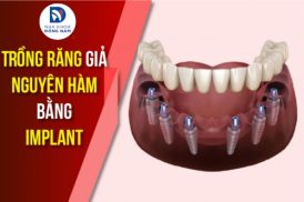 Trồng Răng Giả Nguyên Hàm Bằng Implant