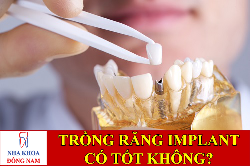 trồng răng implant có tốt không -1