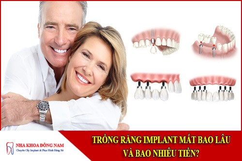 trồng răng implant mất bao lâu và bao nhiêu tiền
