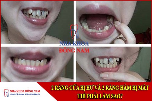 2 răng cửa bị hư và 2 răng hàm bị mất thì phải làm sao