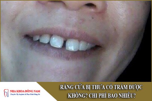 răng cửa bị thưa có trám được không và bao nhiêu tiền