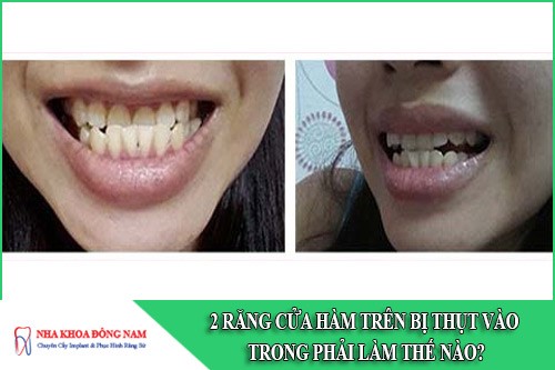 2 răng cửa hàm trên bị thụt vào trong phải làm thế nào
