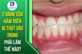 2 răng cửa hàm trên bị thụt vào trong phải làm thế nào