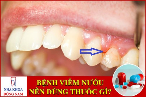 Bệnh viêm nướu răng uống thuốc gì