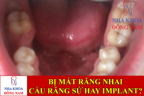 bị mất răng nhai nên làm cầu răng sứ hay trồng implant -1