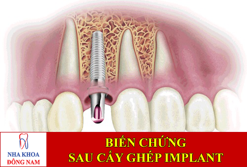 biến chứng sau khi cấy ghép implant -1