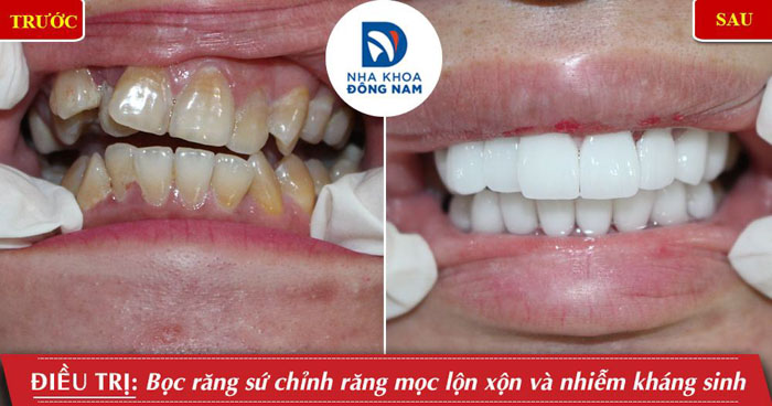 Bọc răng sứ khắc phục răng mọc lộn xộn