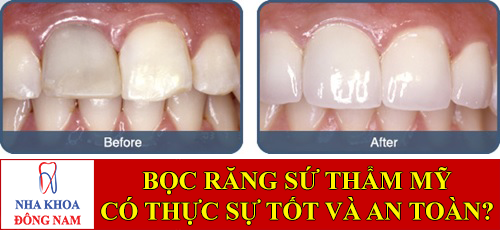 bọc răng sứ thẩm mỹ có tốt và an toàn không -1