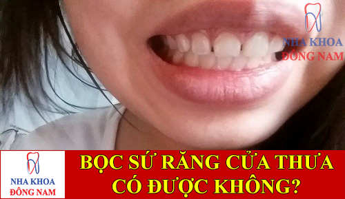 bọc sứ cho răng cửa thưa có được không -1