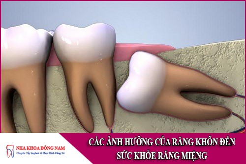 các ảnh hưởng của răng khôn đến sức khỏe răng miệng