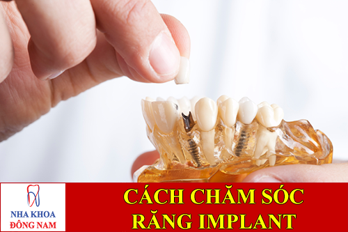 cách chăm sóc răng implant sau khi cấy ghép -1