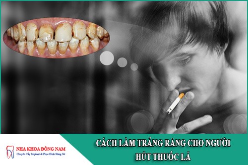 cách làm trắng răng cho người hút thuốc lá