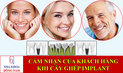 cảm nhận khách hàng khi cấy ghép implant -1