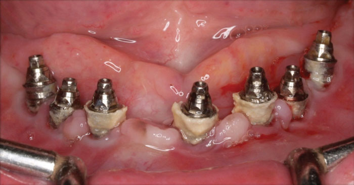 Cao răng tích tụ gây viêm nhiễm quanh Implant