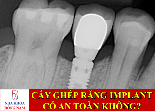 cấy ghép răng implant có an toàn không -1