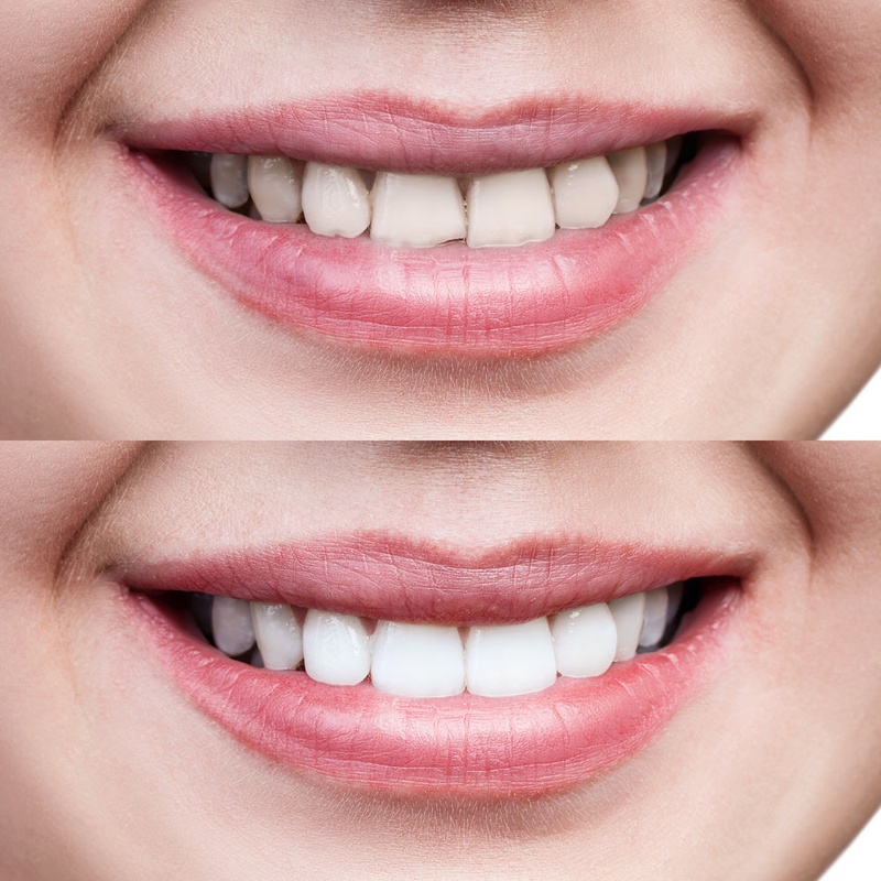 Chi phí bọc răng sứ phụ thuộc vào vị trí và số lượng răng sứ cần phục hình