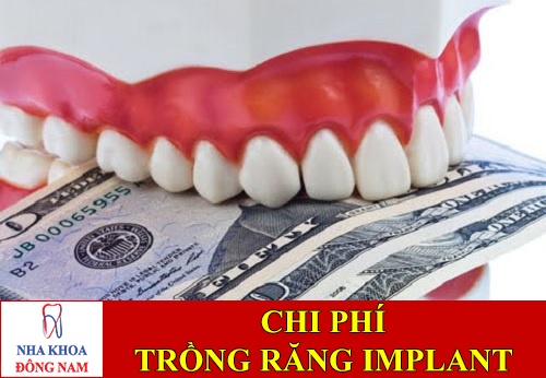 chi phí trồng răng implant bao nhiêu -1