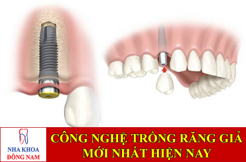 công nghệ trồng răng giả mới nhất hiện nay -1