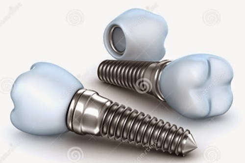 cấy ghép răng implant sử dụng bao lâu 1