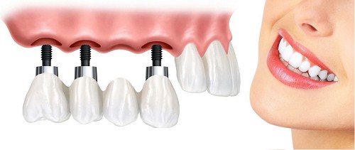 cấy ghép răng implant sử dụng bao lâu 3