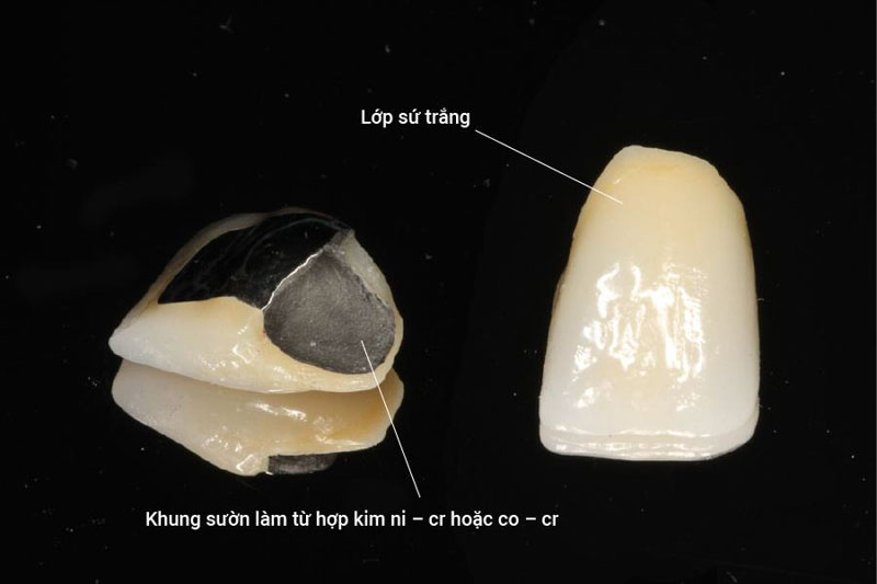 Đặc điểm của răng sứ kim loại thường