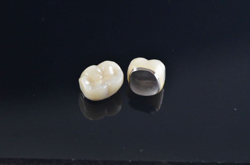 Đặc điểm của răng sứ Titan