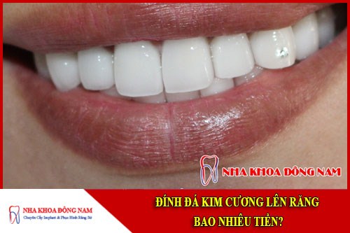 đính đá lên răng bao nhiêu tiền