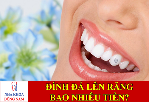 đính đá lên răng bao nhiêu tiền -1