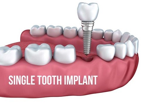 Giải đáp những câu hỏi về cấy ghép răng implant 2
