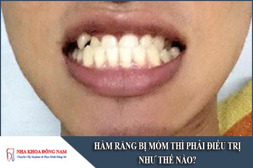 hàm răng bị móm thì phải điều trị như thế nào