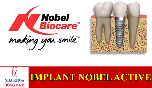 implant nobel active -1