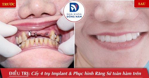 trồng răng implant