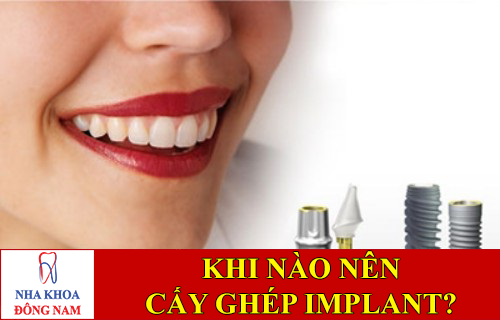 khi nào nên cấy ghép implant -1