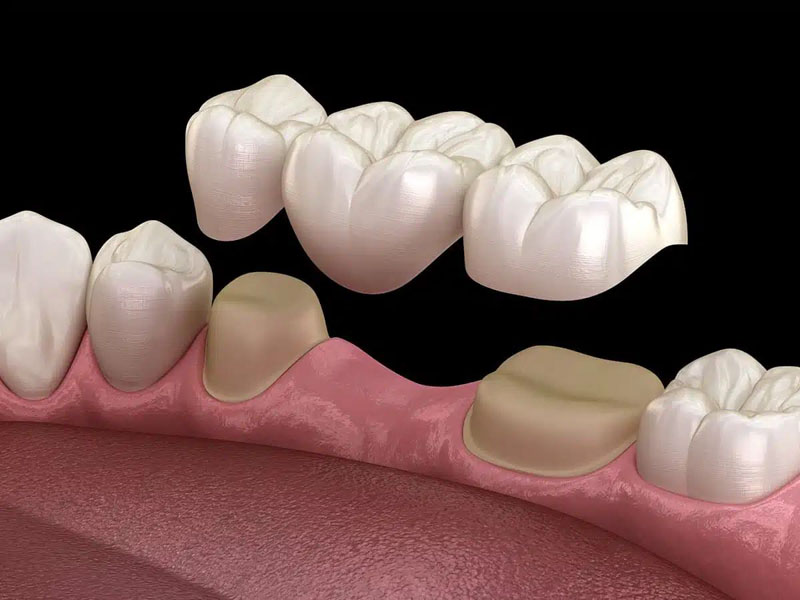 Kỹ thuật làm răng sứ bắc cầu